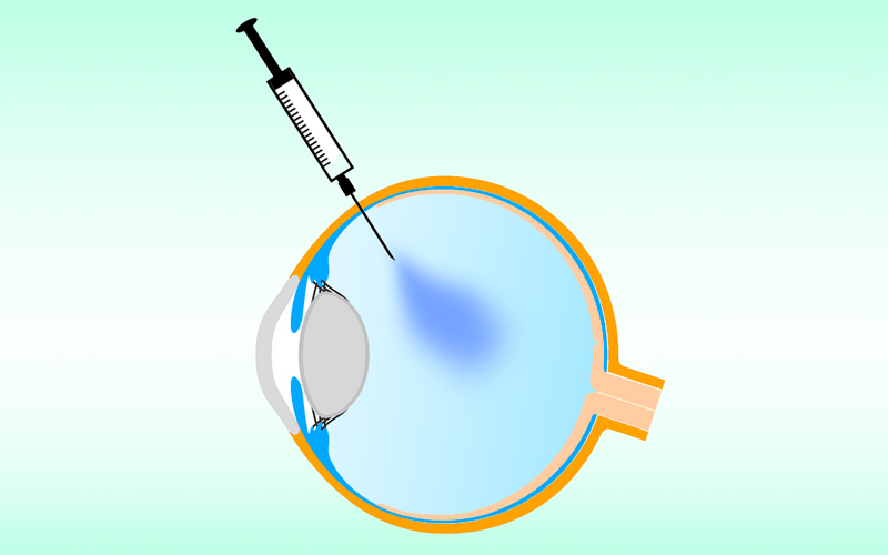 IVOMGRAFIK